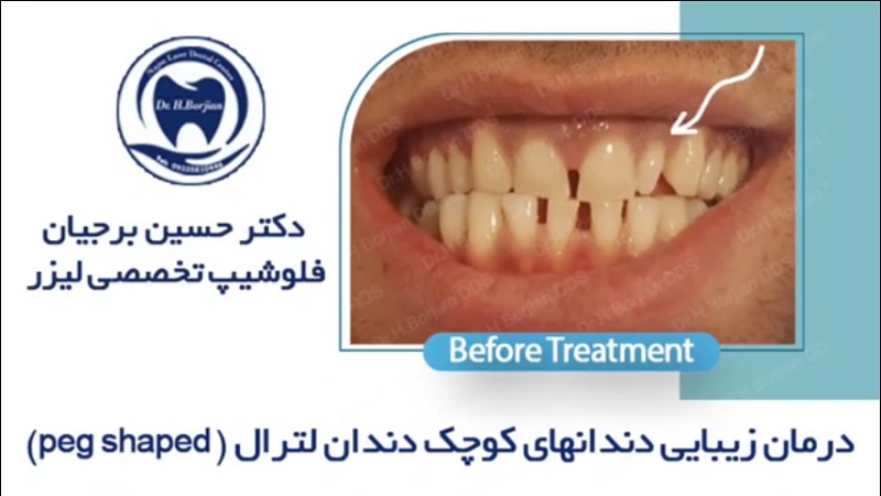 نمونه درمان زیبایی دندان های کوچک لترال