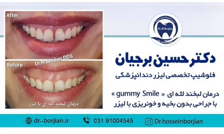 Example of gummy smile treatment with laser surgery