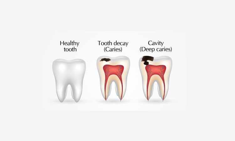 Care tips to prevent tooth decay | The best implant in Isfahan