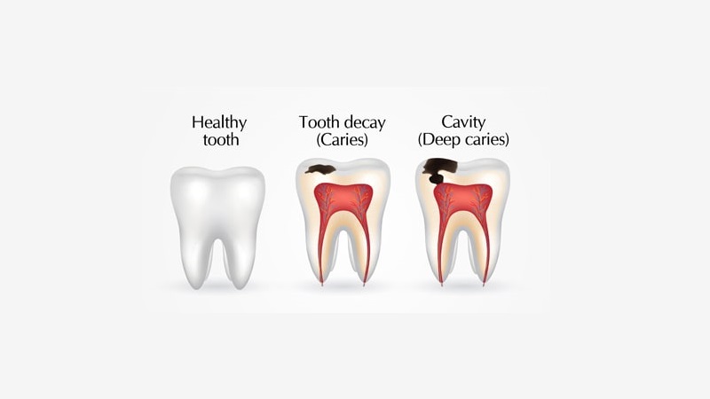 نکات مراقبتی جهت پیشگیری از پوسیدگی دندان | بهترین ایمپلنت اصفهان
