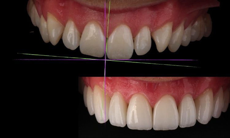 Tips for before correcting the smile design | The best dentist in Isfahan