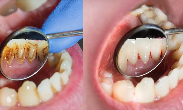 پیشگیری و درمان جرم و پلاک دندانی | بهترین ایمپلنت اصفهان