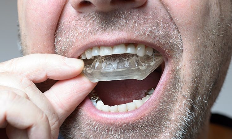 Utilisations des protège-dents | Le meilleur chirurgien des gencives à Ispahan