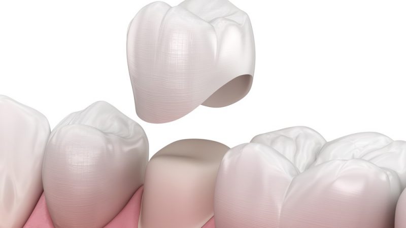 کاربردهای انواع روکش دندان | بهترین دندانپزشک اصفهان