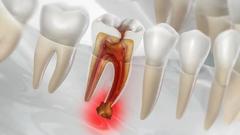 انواع آبسه دندان | بهترین جراح لثه اصفهان