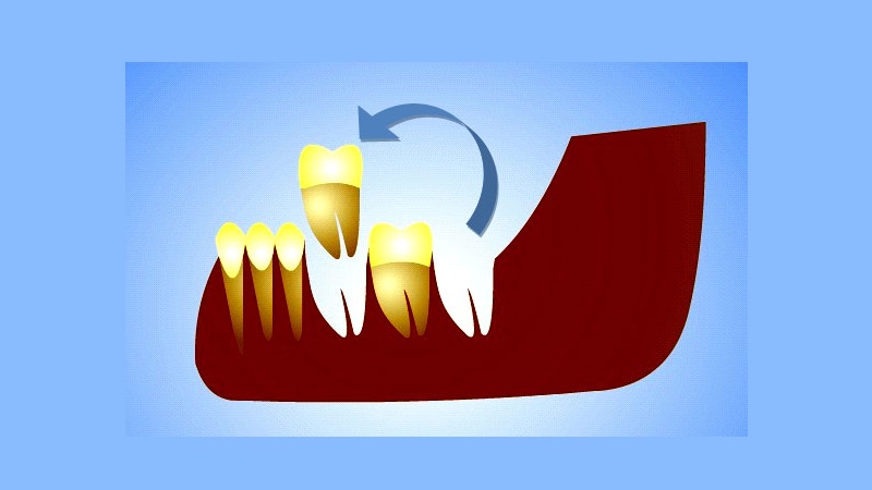 ترنسپلنت دندان عقل | بهترین ایمپلنت اصفهان