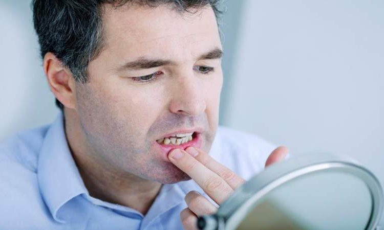 Diagnosing the causes of oral allergy syndrome | The best dentist in Isfahan