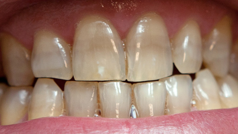 دلایل ایجاد تغییر رنگ در روکش دندان | بهترین ایمپلنت اصفهان