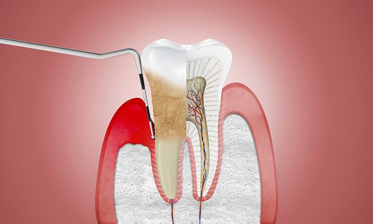 طرق الوقاية والعلاج من خراج الأسنان | افضل دكتور اسنان تجميلي في اصفهان