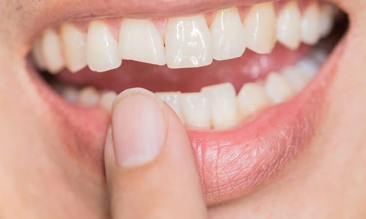 أسباب تلف قشرة الأسنان | افضل دكتور اسنان تجميلي في اصفهان