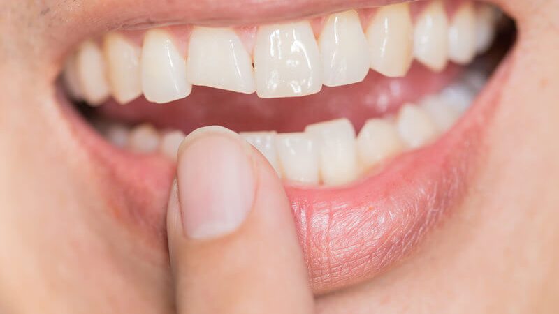 علل آسیب‌ دیدن روکش دندان | بهترین دندانپزشک زیبایی اصفهان