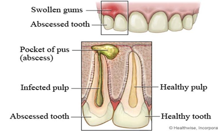 Causes des infections des dents et des gencives | Le meilleur chirurgien des gencives à Ispahan