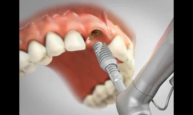 علل کاشت ایمپلنت دندان جلویی | بهترین جراح لثه اصفهان