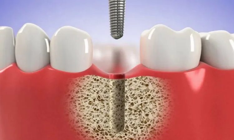 عوامل فعالة في تسريع اللحام بزراعة الاسنان | افضل دكتور اسنان تجميلي في اصفهان