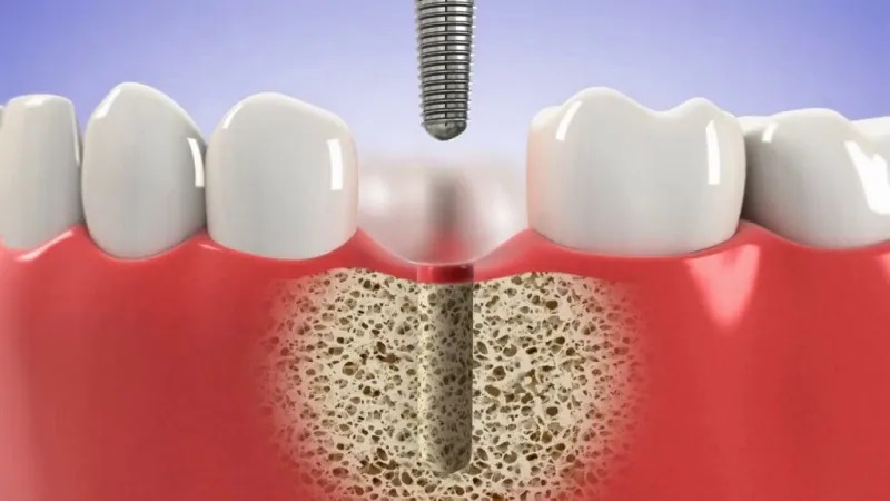 Effective factors in accelerating the welding of dental implants | The best cosmetic dentist in Isfahan