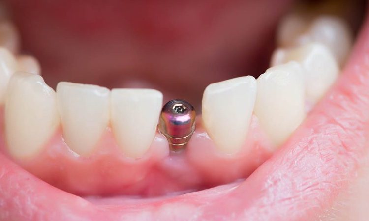 مراقبت از ایمپلنت دندان های جلو | بهترین جراح لثه اصفهان