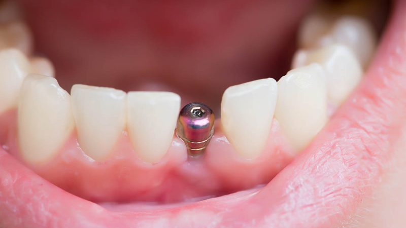 مراقبت از ایمپلنت دندان های جلو | بهترین جراح لثه اصفهان