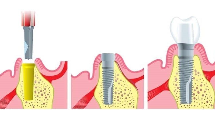 Précautions pour la fusion précoce de l'implant | Le meilleur dentiste d'Ispahan