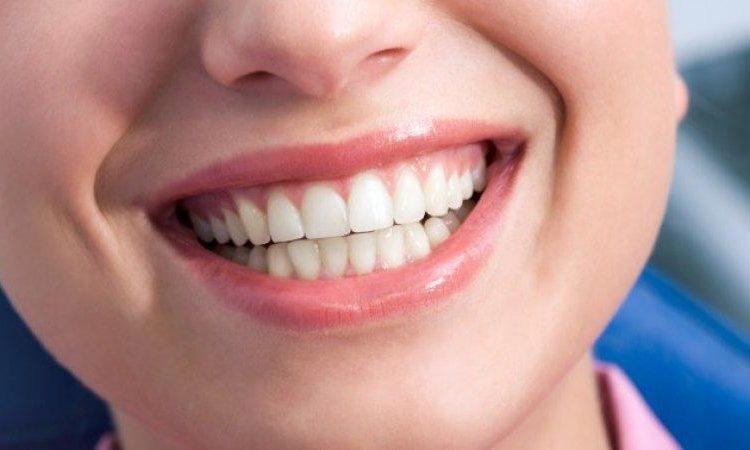 Avantages et inconvénients du collage dentaire | Le meilleur implant à Ispahan