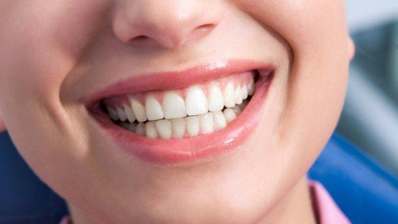 Advantages and disadvantages of dental bonding | The best implant in Isfahan