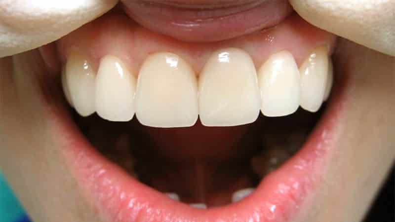 مقایسه ایمپلنت دندان های جلو با بریج | بهترین ایمپلنت اصفهان
