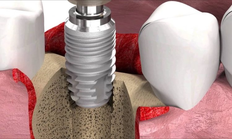 Comment fusionner les implants dentaires au tissu osseux naturel | Le meilleur dentiste cosmétique à Ispahan