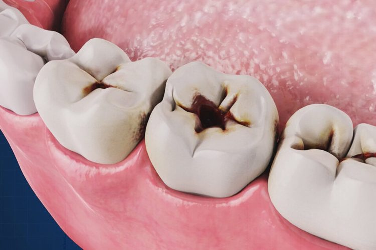 پیشگری و درمان پوسیدگی دندان | بهترین ایمپلنت اصفهان
