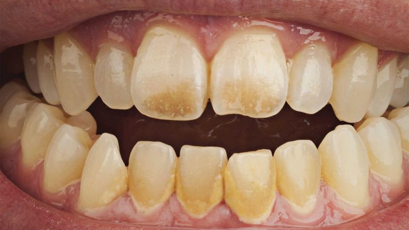 پیشگیری از تغییر رنگ دندان ها | بهترین دندانپزشک زیبایی اصفهان