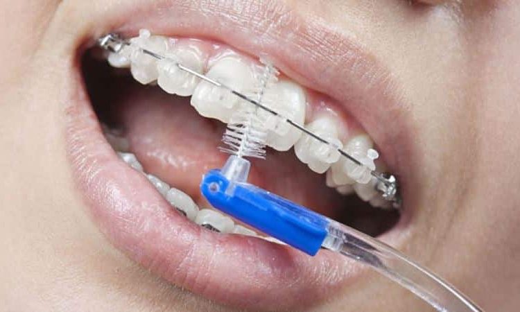 Application et types de brosse dentaire | Le meilleur dentiste cosmétique à Ispahan