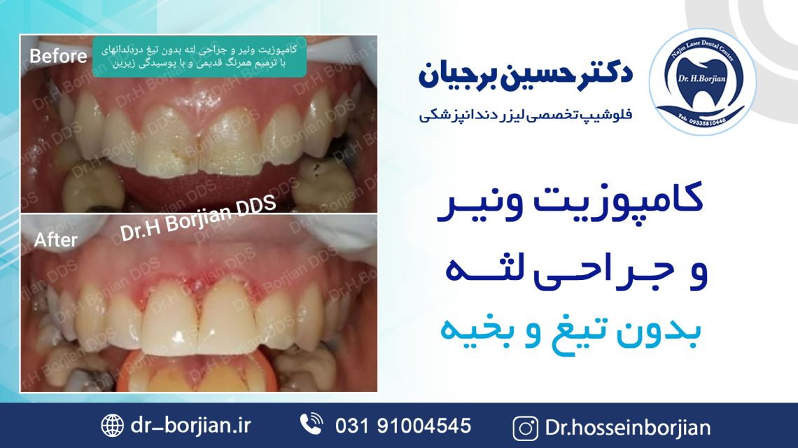 کامپوزیت ونیر و جراحی لثه بدون تیغ|بهترین دندانپزشک اصفهان