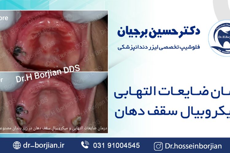 علاج الآفات الالتهابية والميكروبية لسقف الفم|افضل دكتور اسنان في اصفهان