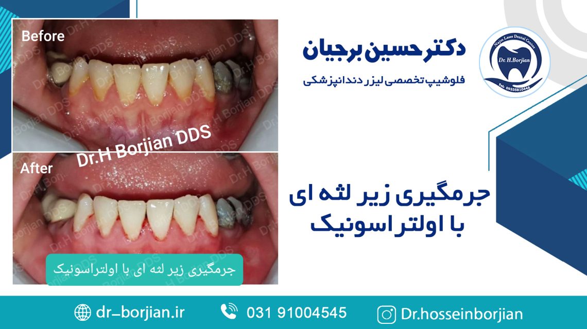 جرمگیری زیر لثه ای با اولتراسونیک (14) | بهترین دندانپزشک اصفهان