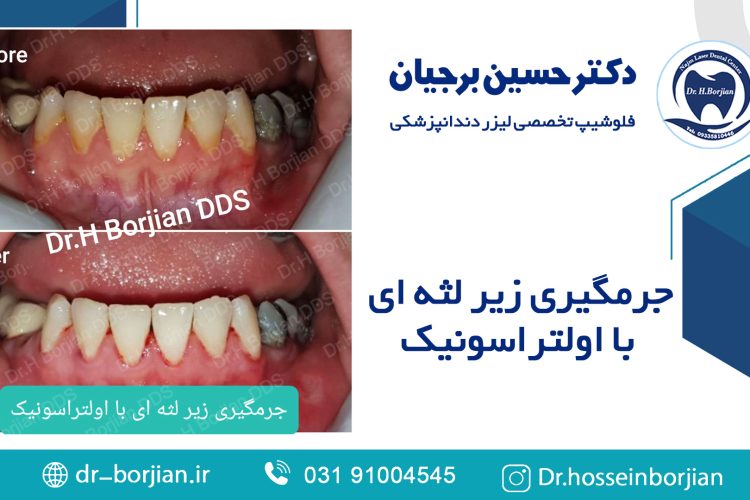 جرمگیری زیر لثه ای با اولتراسونیک (14) | بهترین دندانپزشک اصفهان