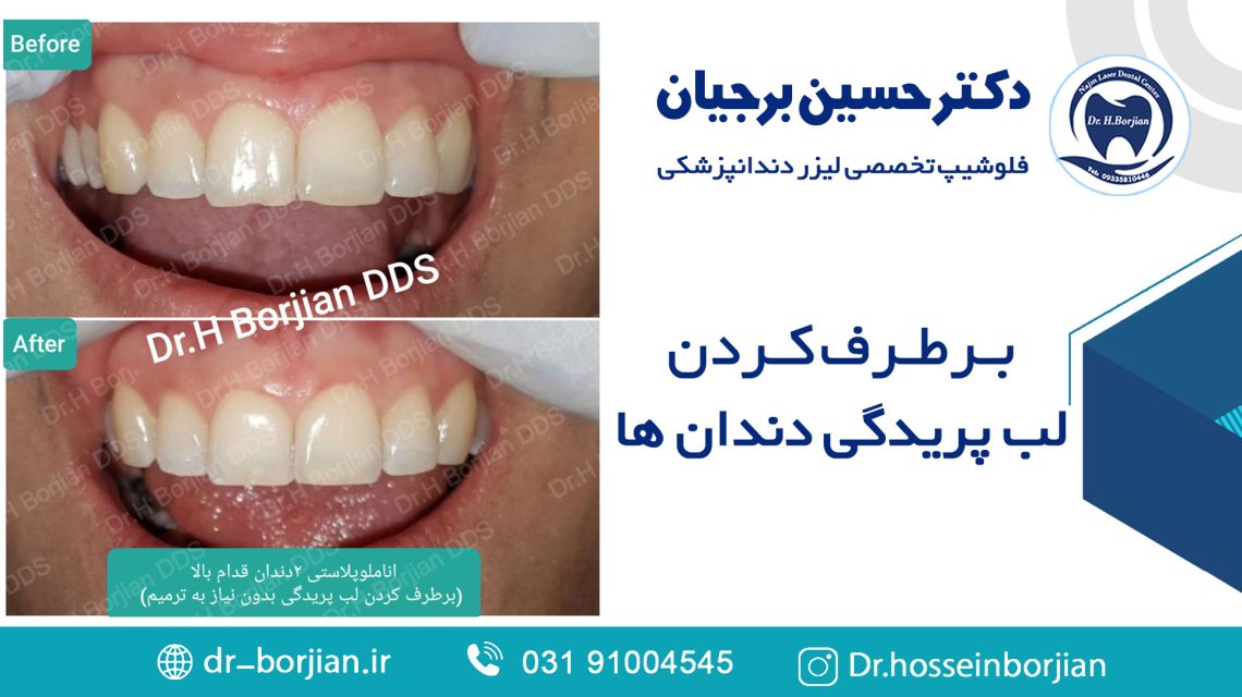 برطرف کردن لب پریدگی دندان بدون نیاز به ترمیم|بهترین دندانپزشک اصفهان