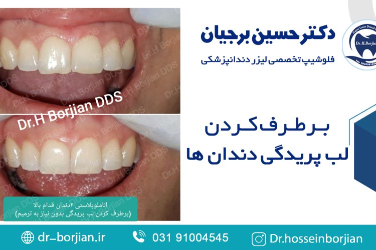 برطرف کردن لب پریدگی دندان بدون نیاز به ترمیم|The best dentist in Isfahan