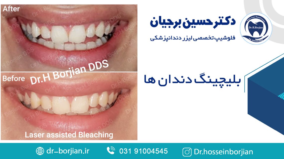 نمونه بلیچینگ دندان | بهترین دندانپزشک اصفهان