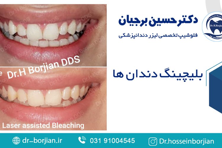 مثال على تبييض الأسنان | افضل دكتور اسنان في اصفهان