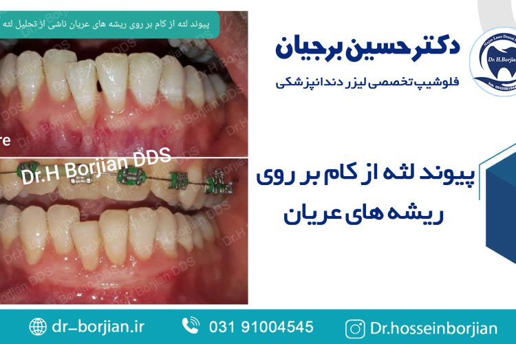 پیوند لثه از کام بر روی ریشه های عریان | بهترین دندانپزشک اصفهان