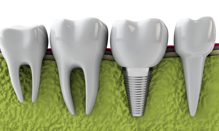Raisons d'avoir besoin d'implants dentaires | Le meilleur dentiste cosmétique à Ispahan