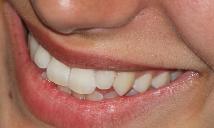 Treatment methods for dark teeth | The best dentist in Isfahan