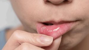 The most common types of oral infections | The best cosmetic dentist in Isfahan