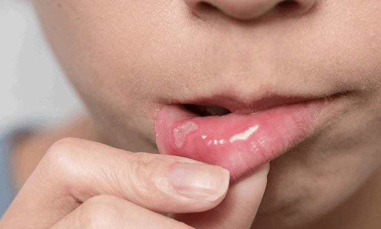 The most common types of oral infections | The best cosmetic dentist in Isfahan
