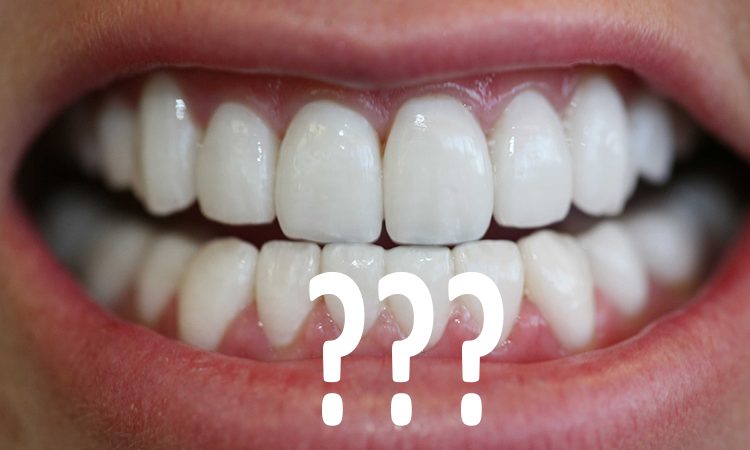 Conditions for using composite veneers on teeth | The best cosmetic dentist in Isfahan