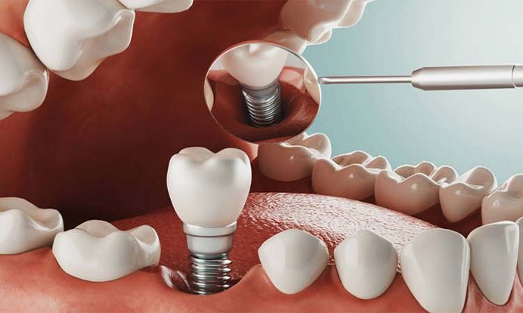 طول دوره کاشت ایمپلنت دندان چقدر است؟ | Le meilleur dentiste d'Ispahan