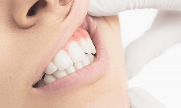 Symptoms associated with gum pain | The best dentist in Isfahan