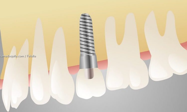 Facteurs efficaces pour augmenter la durée de vie des implants | Le meilleur dentiste d'Ispahan