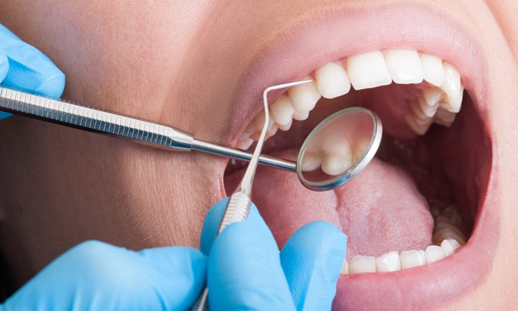 Avantages et inconvénients du collage dentaire | Le meilleur dentiste d'Ispahan