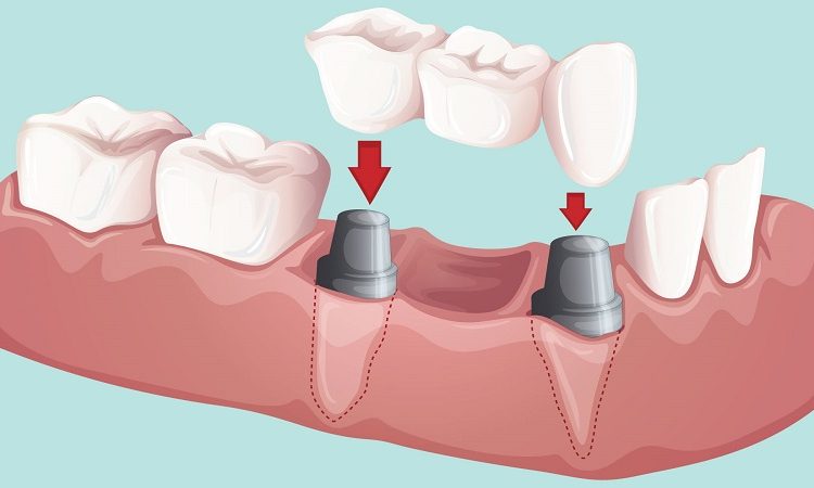 Application de tous types de bridges dentaires | Le meilleur implant à Ispahan