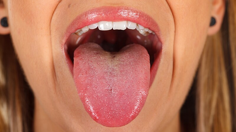 Diagnostiquer les symptômes du cancer de la langue | Le meilleur ...