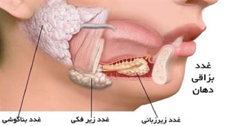 Traitement et gestion des troubles des glandes salivaires | Le meilleur dentiste d'Ispahan - le meilleur chirurgien des gencives d'Ispahan - le meilleur dentiste cosmétique d'Ispahan
